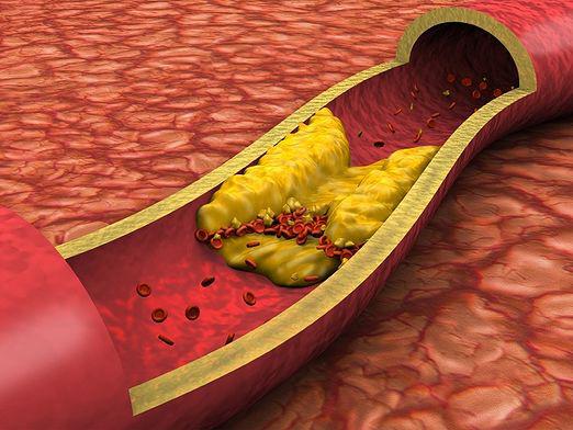 Atherosclerosis: איך לטפל?